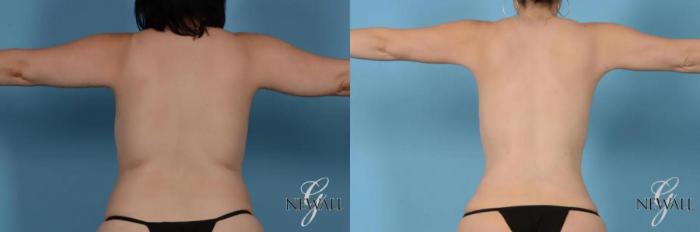 Before & After Liposuction Case 17442 View 2 View in Houston, TX