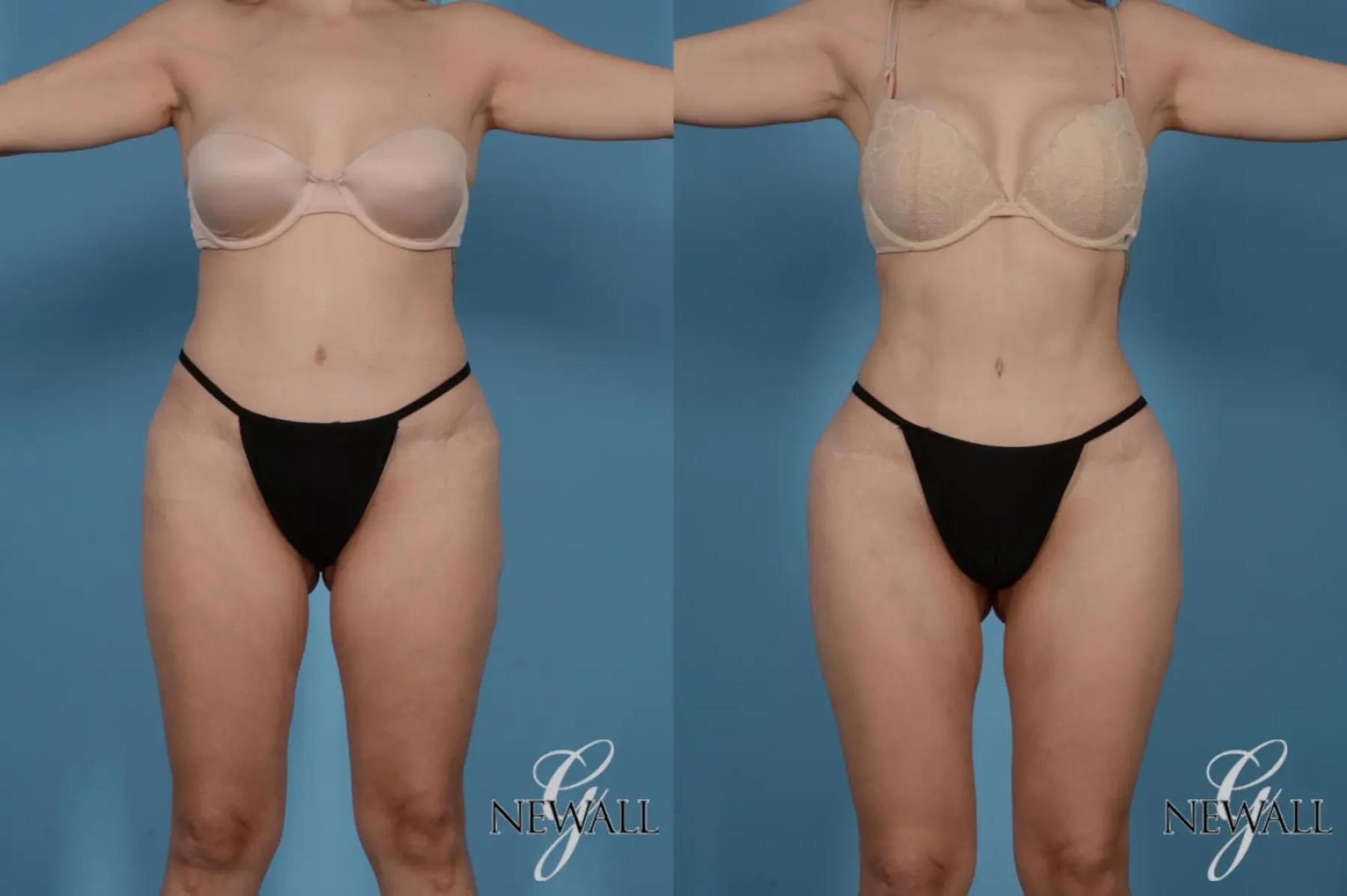 Before & After Liposuction Case 17519 View 1 View in Houston, TX