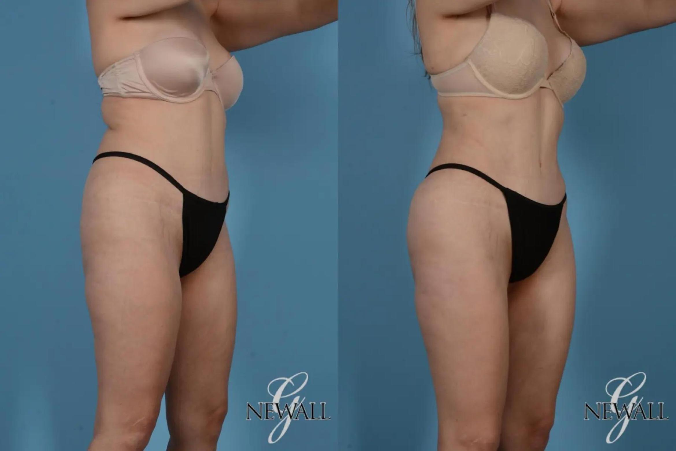 Before & After Liposuction Case 17519 View 2 View in Houston, TX