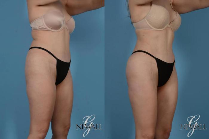 Before & After Liposuction Case 17519 View 2 View in Houston, TX