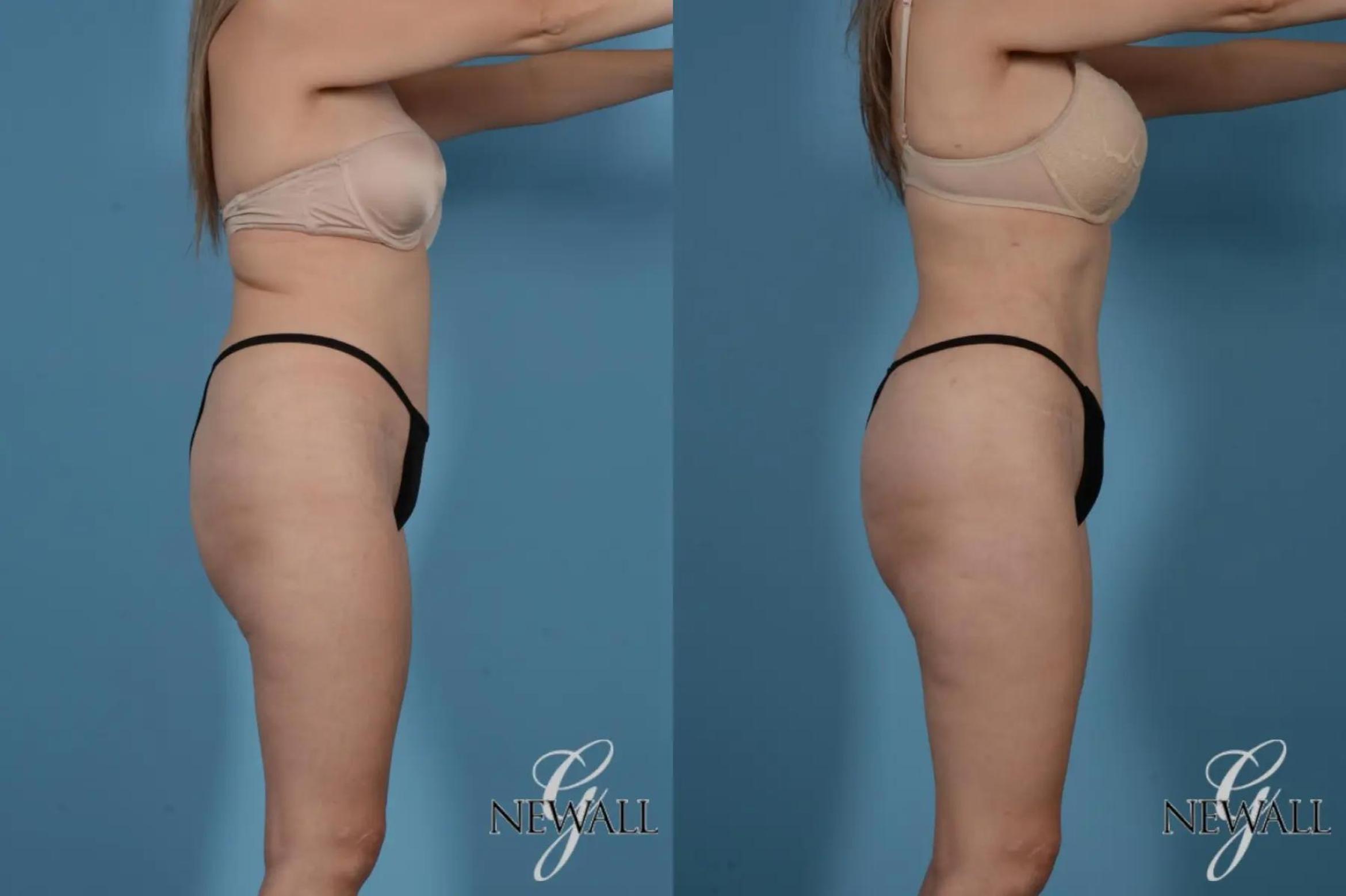 Before & After Liposuction Case 17519 View 3 View in Houston, TX