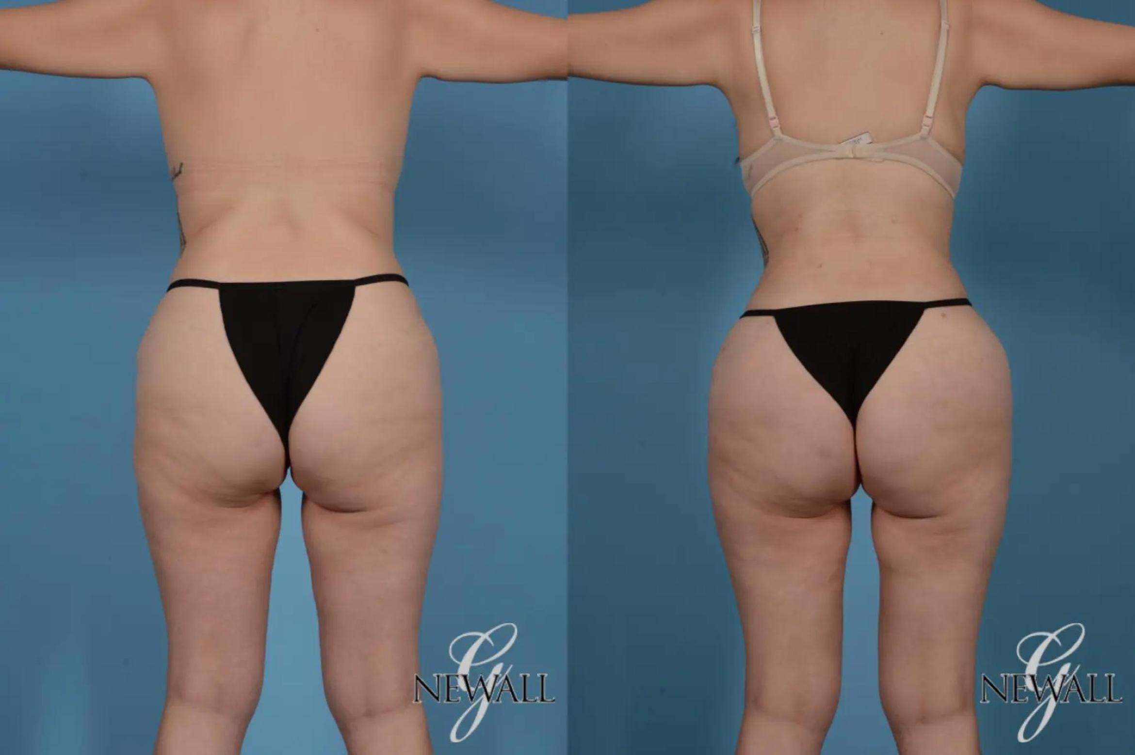 Before & After Liposuction Case 17519 View 4 View in Houston, TX
