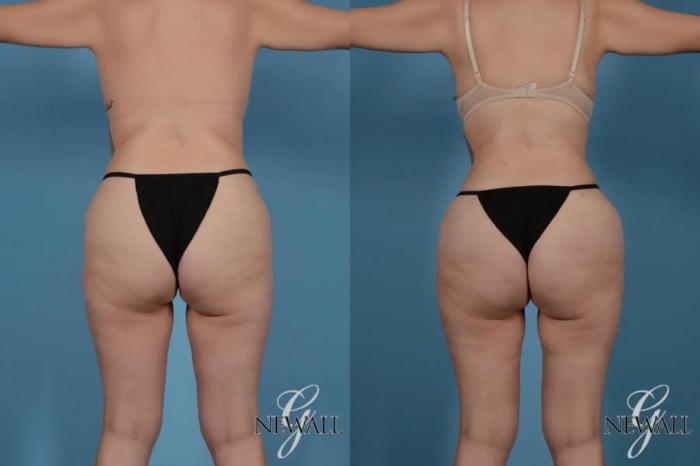 Before & After Liposuction Case 17519 View 4 View in Houston, TX