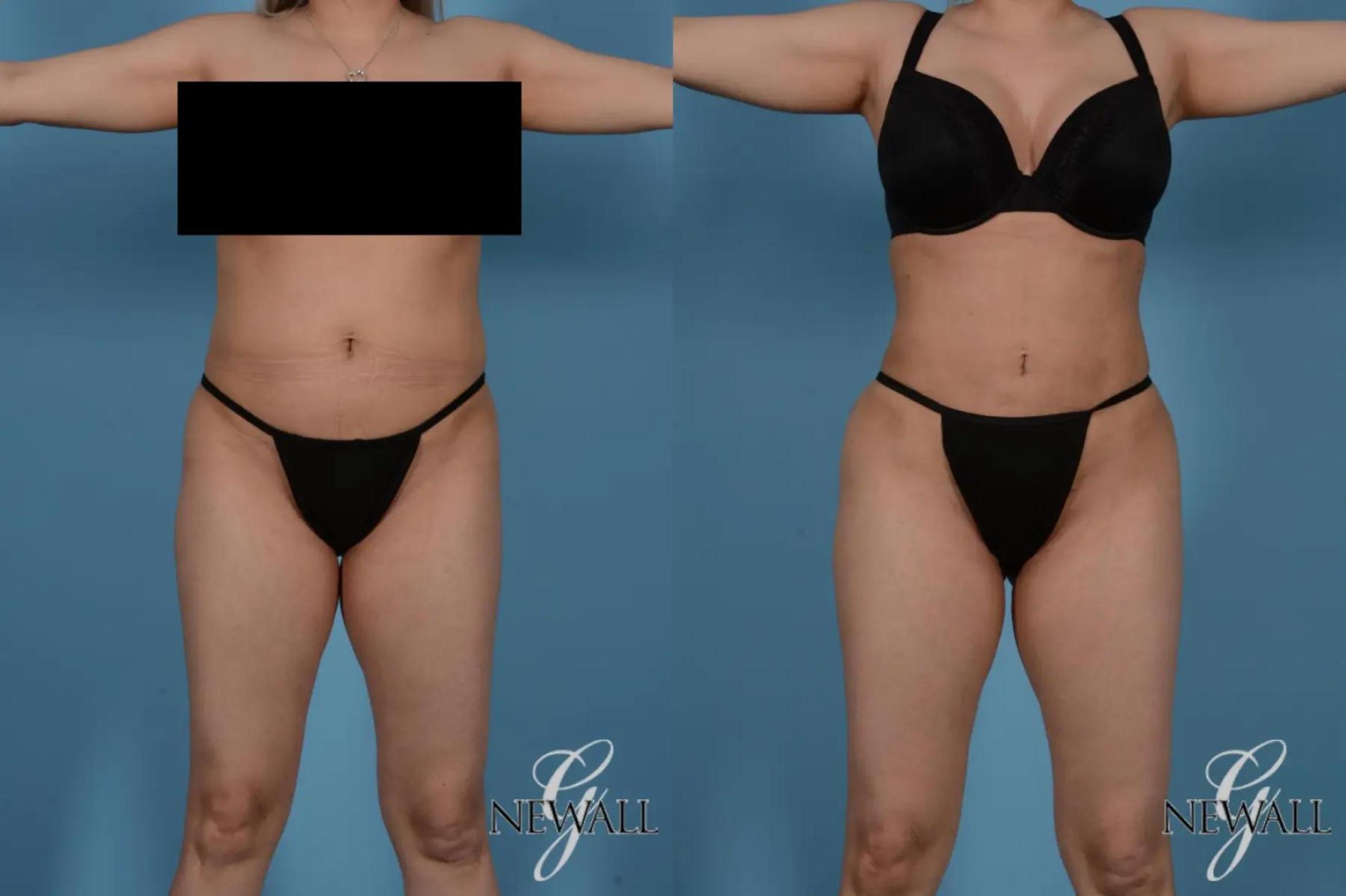 Before & After Liposuction Case 17524 View 1 View in Houston, TX
