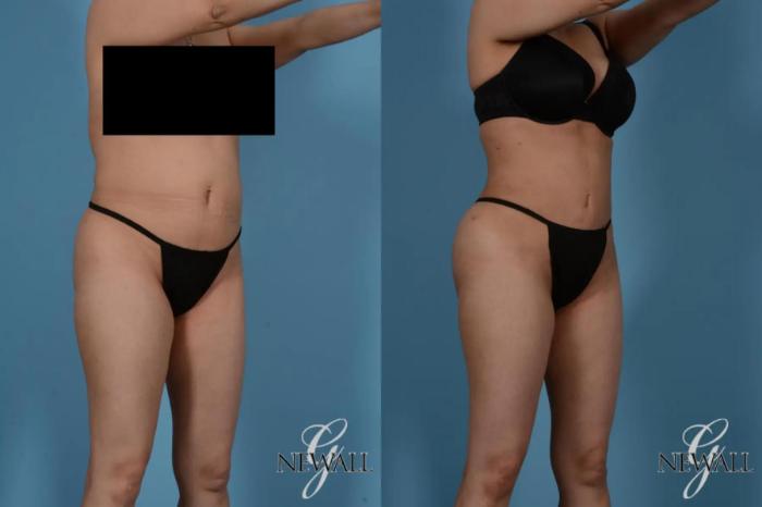 Before & After Liposuction Case 17524 View 2 View in Houston, TX