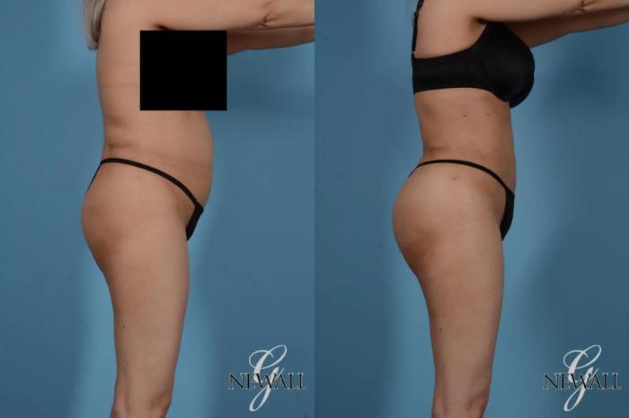 Before & After Liposuction Case 17524 View 3 View in Houston, TX