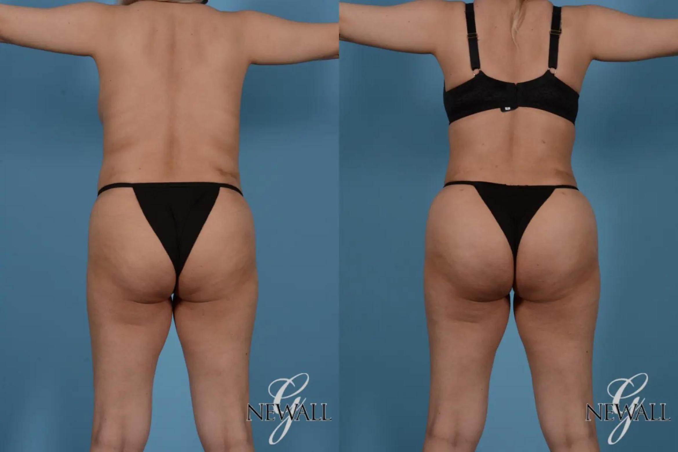 Before & After Liposuction Case 17524 View 4 View in Houston, TX