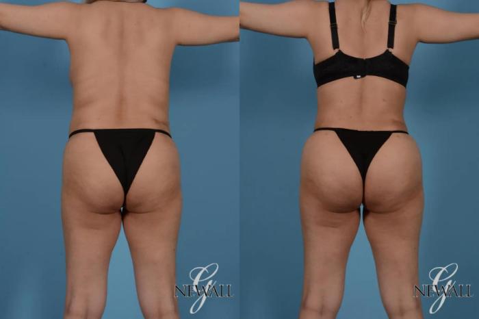Before & After Liposuction Case 17524 View 4 View in Houston, TX