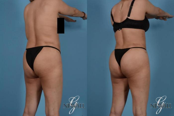 Before & After Liposuction Case 17524 View 5 View in Houston, TX