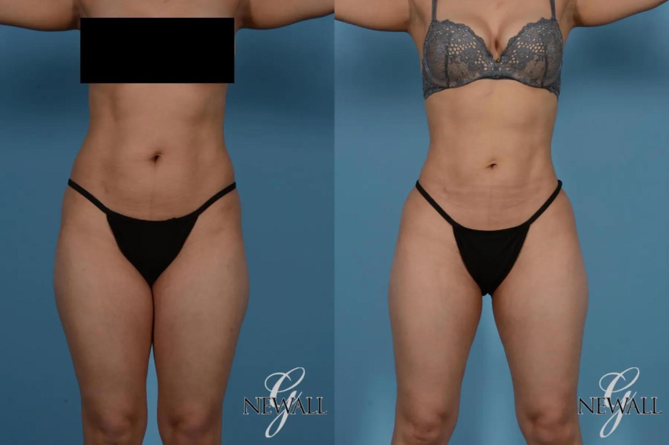 Before & After Liposuction Case 17535 View 1 View in Houston, TX