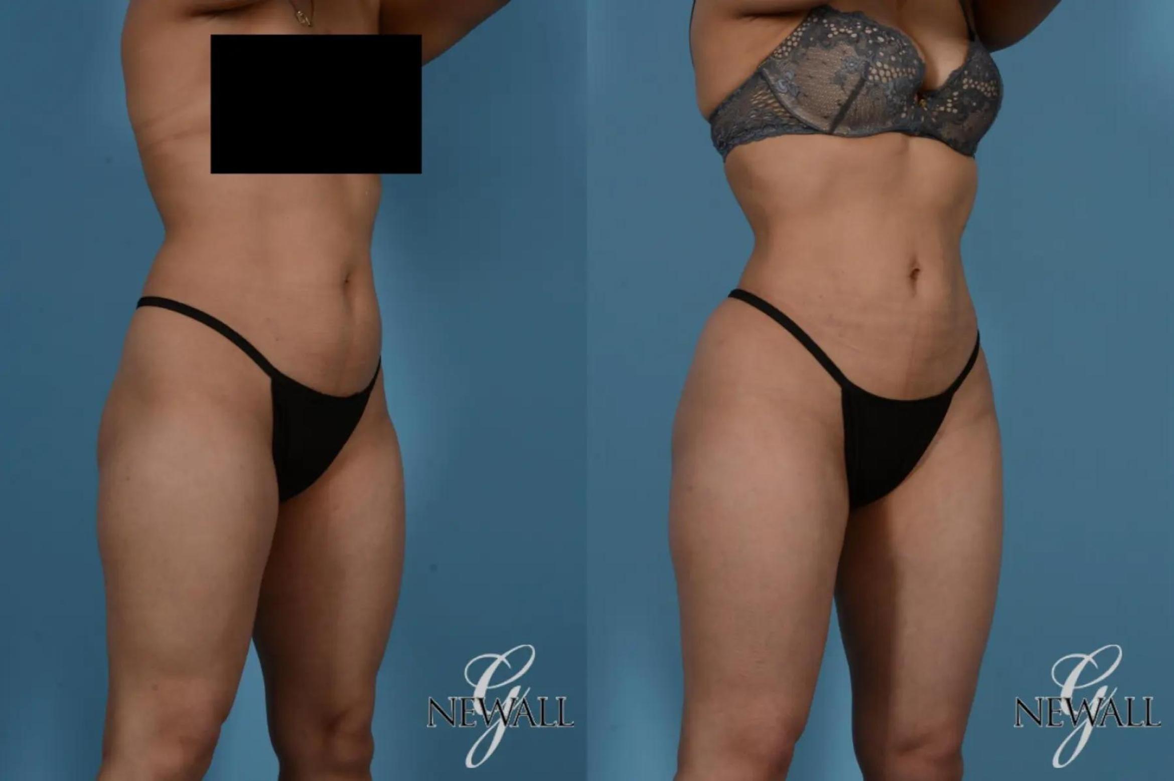 Before & After Liposuction Case 17535 View 2 View in Houston, TX