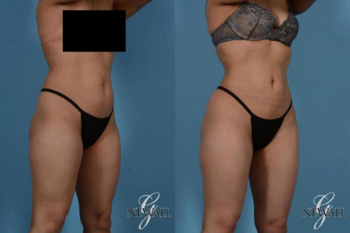 Before & After Liposuction Case 17535 View 2 View in Houston, TX