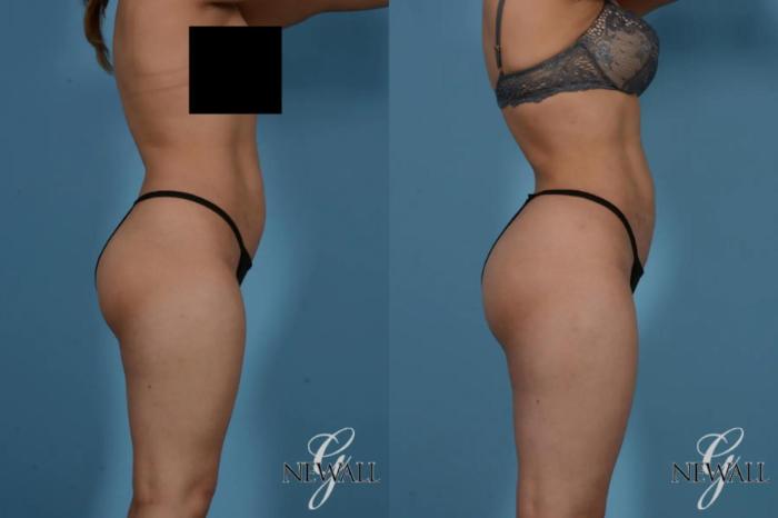 Before & After Liposuction Case 17535 View 3 View in Houston, TX