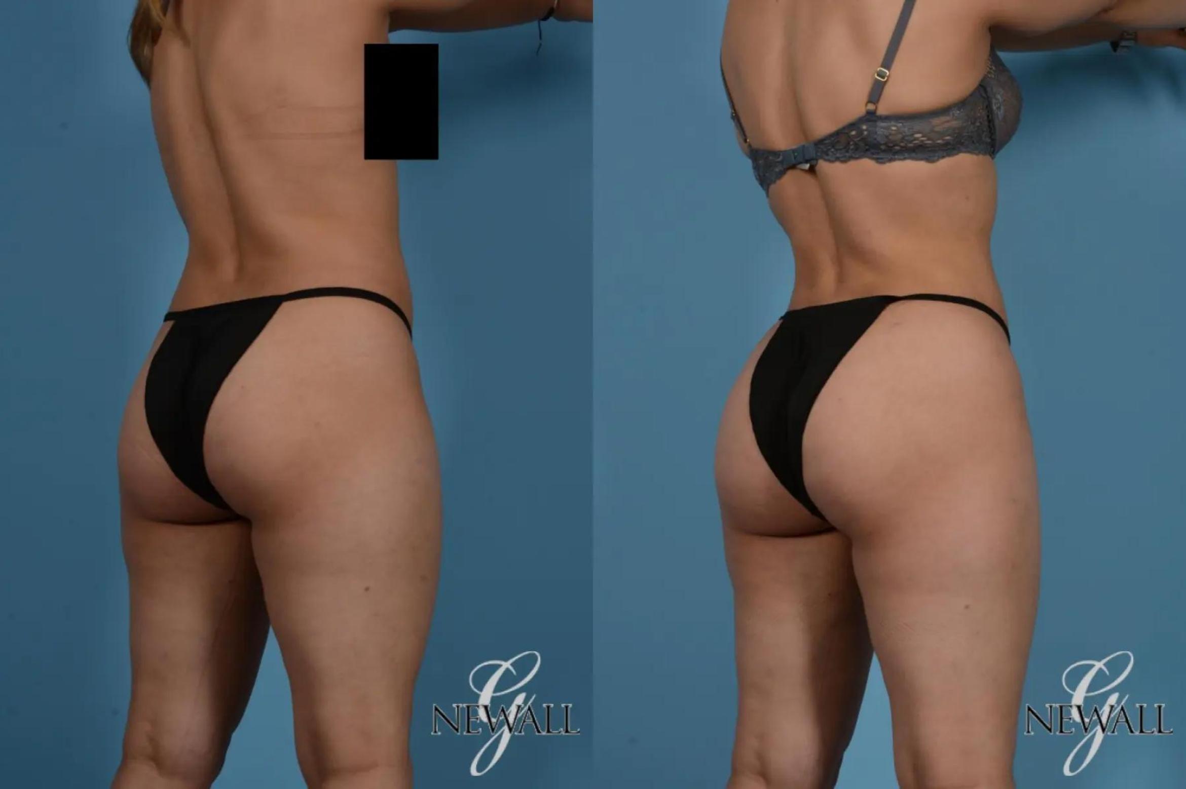 Before & After Liposuction Case 17535 View 4 View in Houston, TX