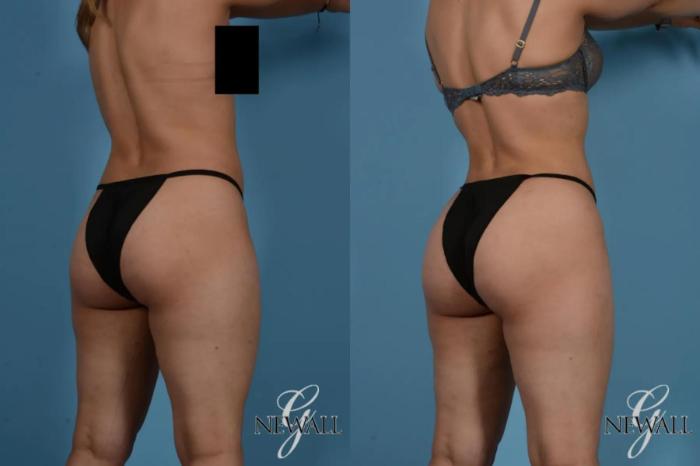 Before & After Liposuction Case 17535 View 4 View in Houston, TX