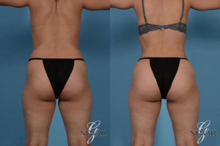 Before & After Liposuction Case 17535 View 5 View in Houston, TX
