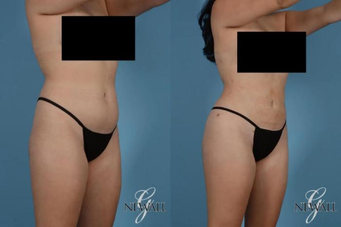 Before & After Liposuction Case 17767 View 2 View in Houston, TX