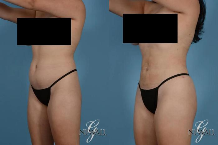 Before & After Liposuction Case 17767 View 3 View in Houston, TX