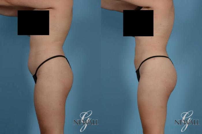 Before & After Liposuction Case 17767 View 4 View in Houston, TX