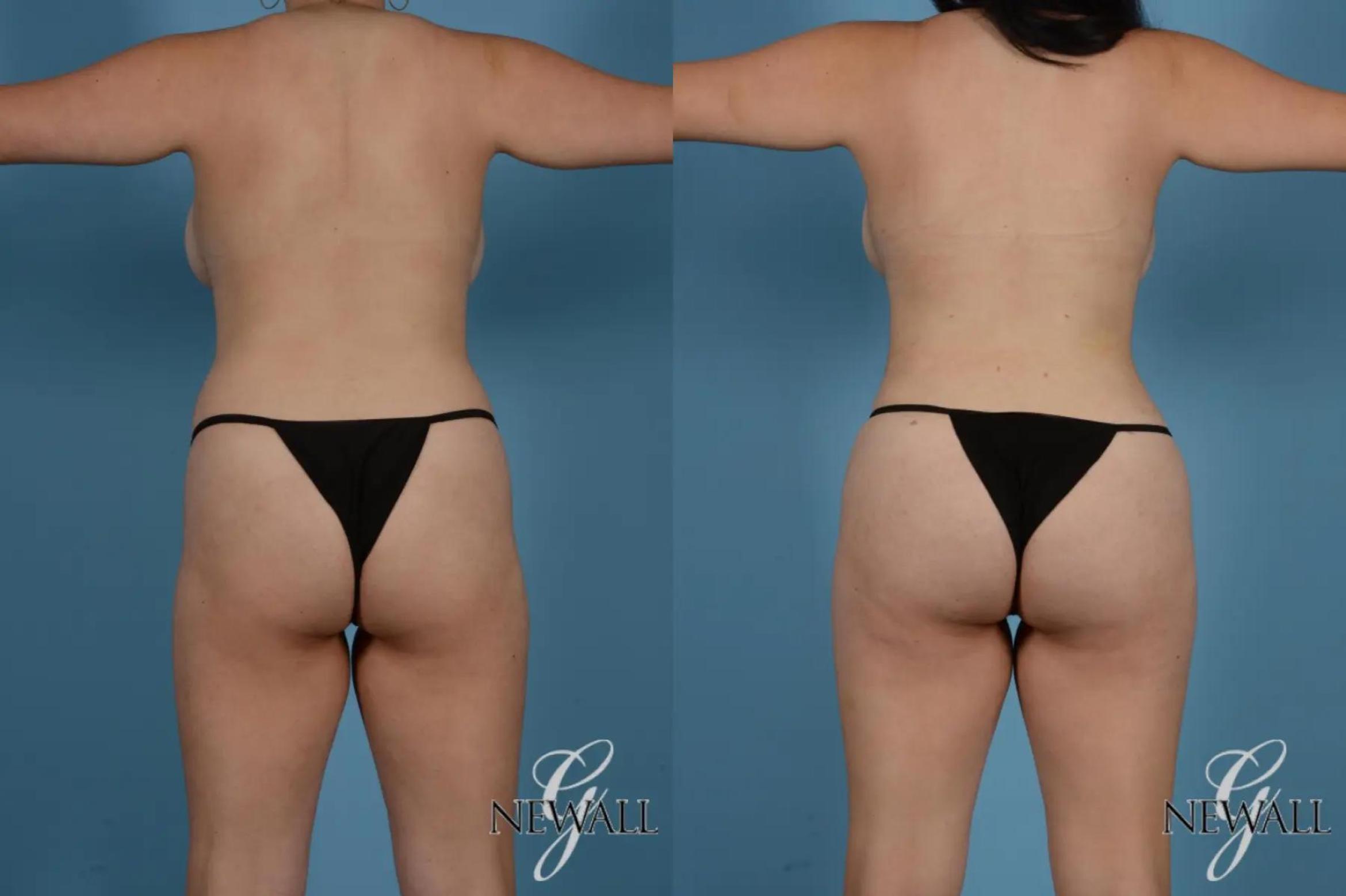 Before & After Liposuction Case 17767 View 5 View in Houston, TX