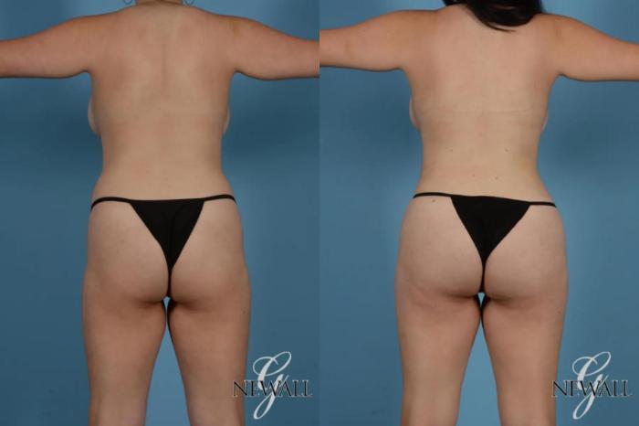 Before & After Liposuction Case 17767 View 5 View in Houston, TX