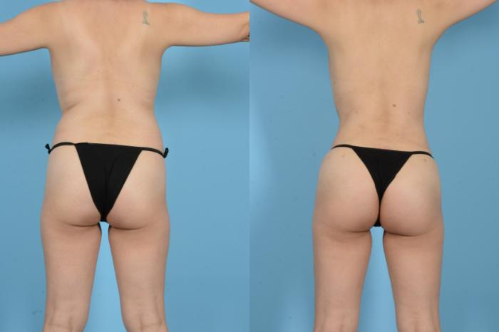 Before & After Brazilian Butt Lift Case 18129 Back View in Houston, TX