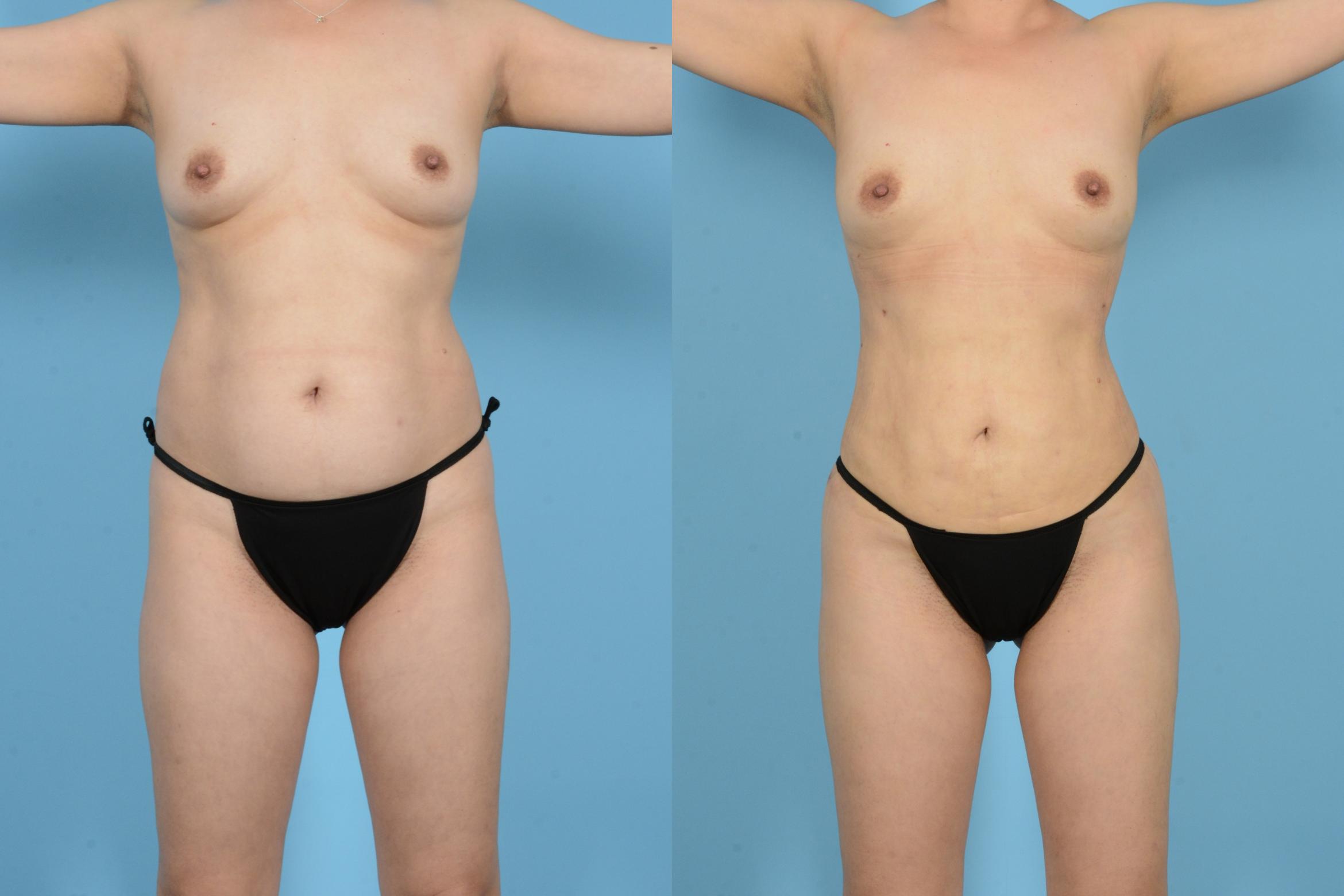 Before & After Brazilian Butt Lift Case 18129 Front View in Houston, TX