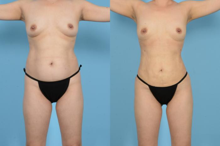 Before & After Brazilian Butt Lift Case 18129 Front View in Houston, TX
