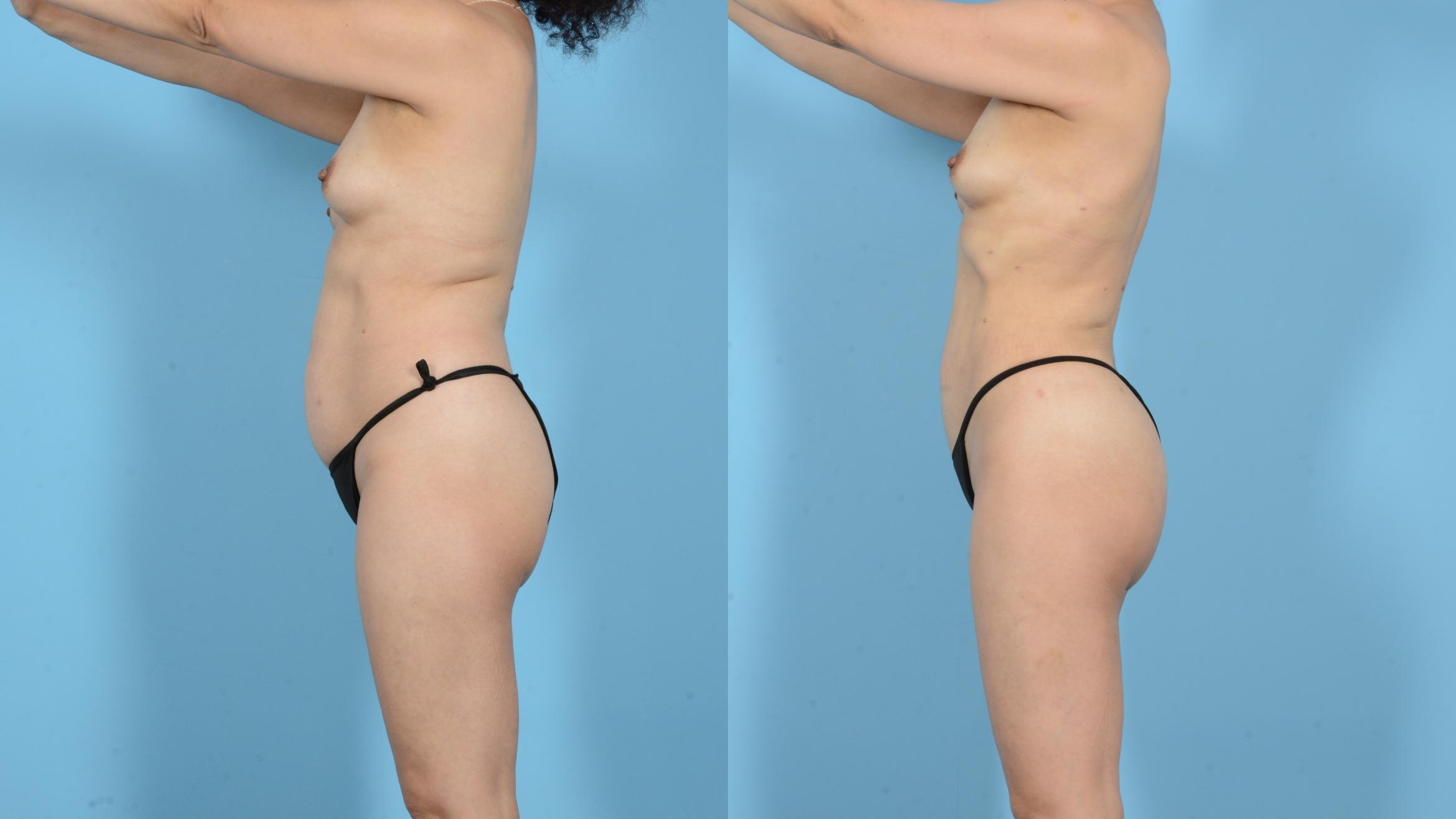 Before & After Liposuction Case 18129 Left Side View in Houston, TX