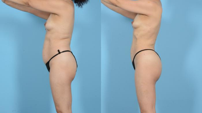 Before & After Liposuction Case 18129 Left Side View in Houston, TX