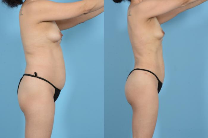 Before & After Brazilian Butt Lift Case 18129 Right Side View in Houston, TX