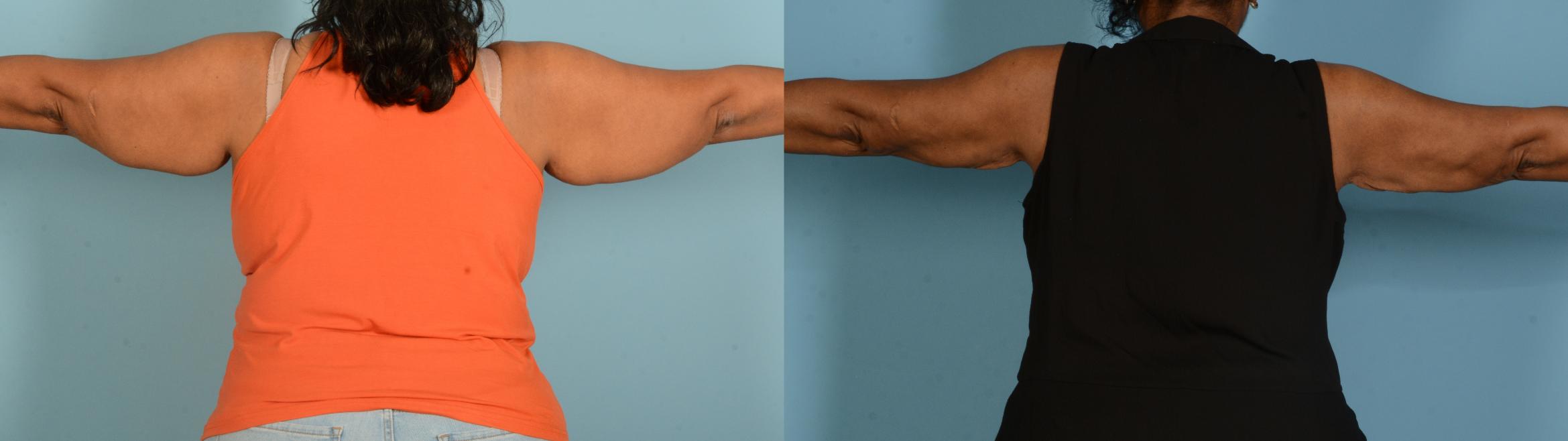 Before & After Body Lift Case 18151 Back View in Houston, TX