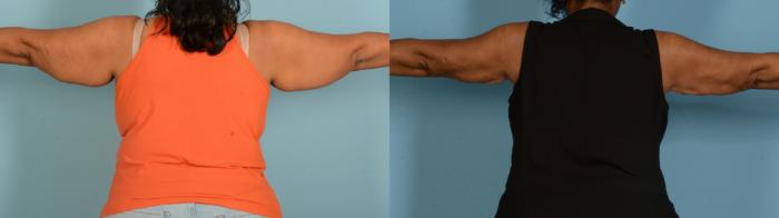 Before & After Body Lift Case 18151 Back View in Houston, TX