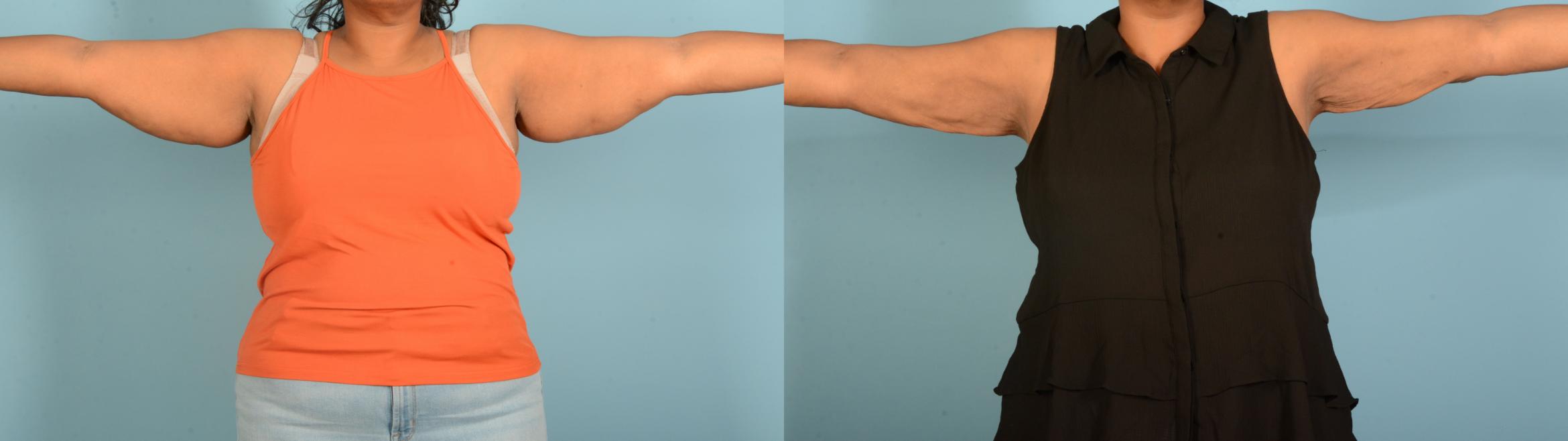 Before & After Body Lift Case 18151 Front View in Houston, TX