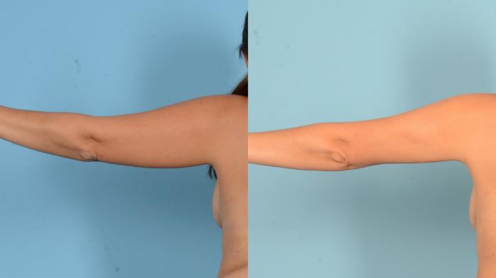 Before & After Liposuction Case 18152 Back Left View in Houston, TX