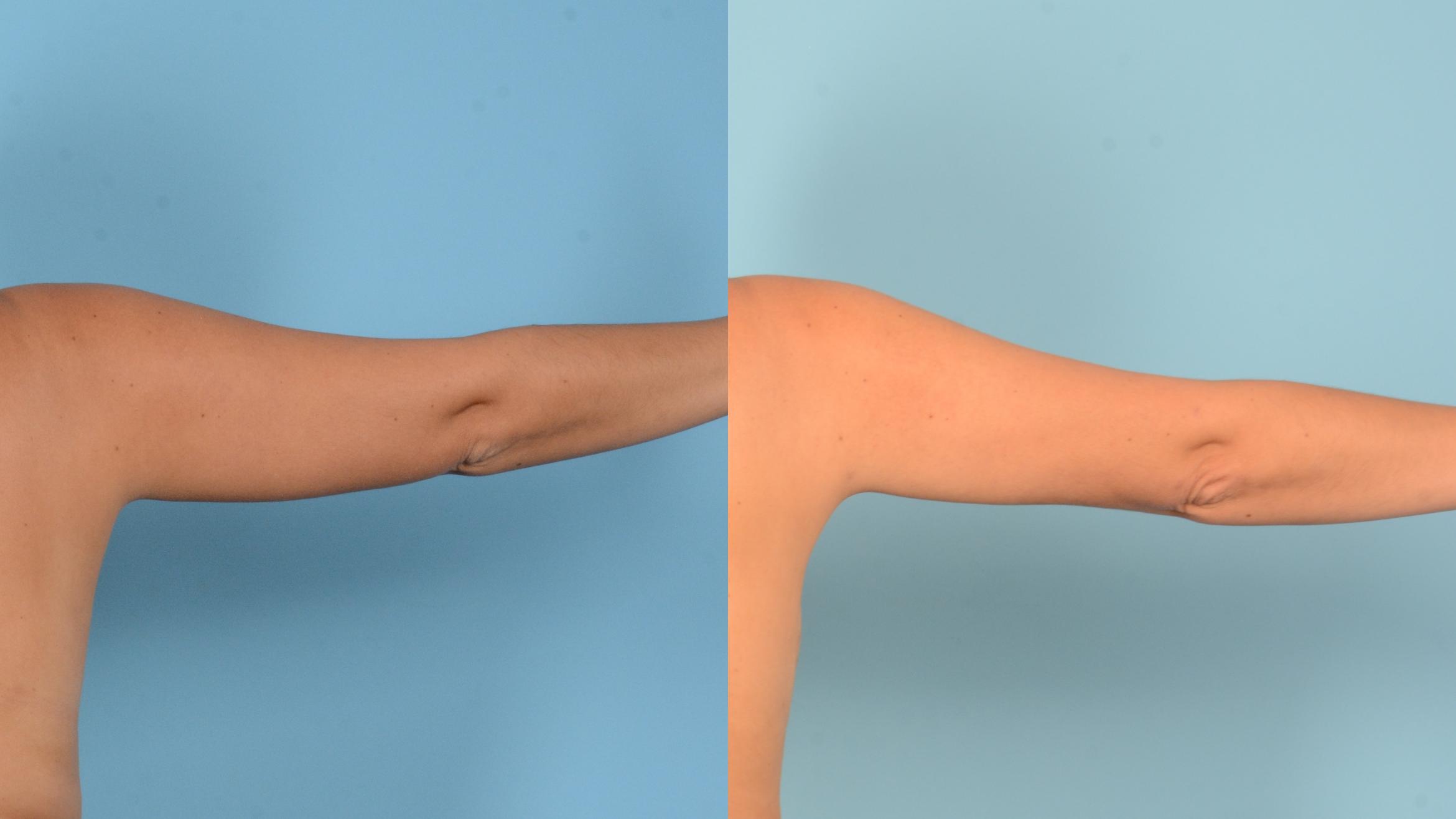 Before & After Liposuction Case 18152 Back Right View in Houston, TX