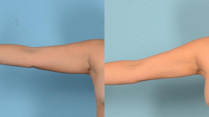 Before & After Liposuction Case 18152 Front Left View in Houston, TX