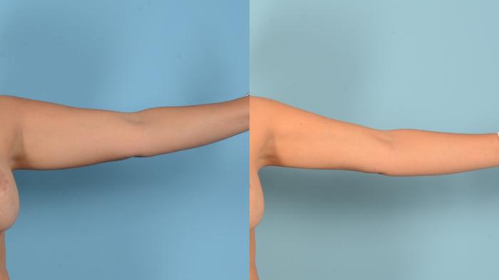 Before & After Liposuction Case 18152 Front Right View in Houston, TX