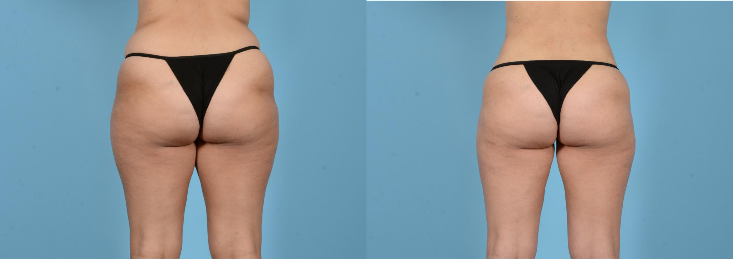 Before & After Liposuction Case 18162 Back View in Houston, TX