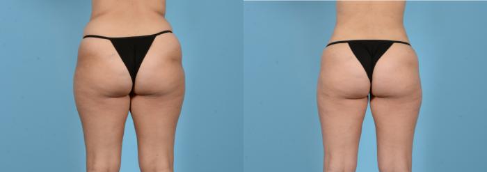 Before & After Liposuction Case 18162 Back View in Houston, TX