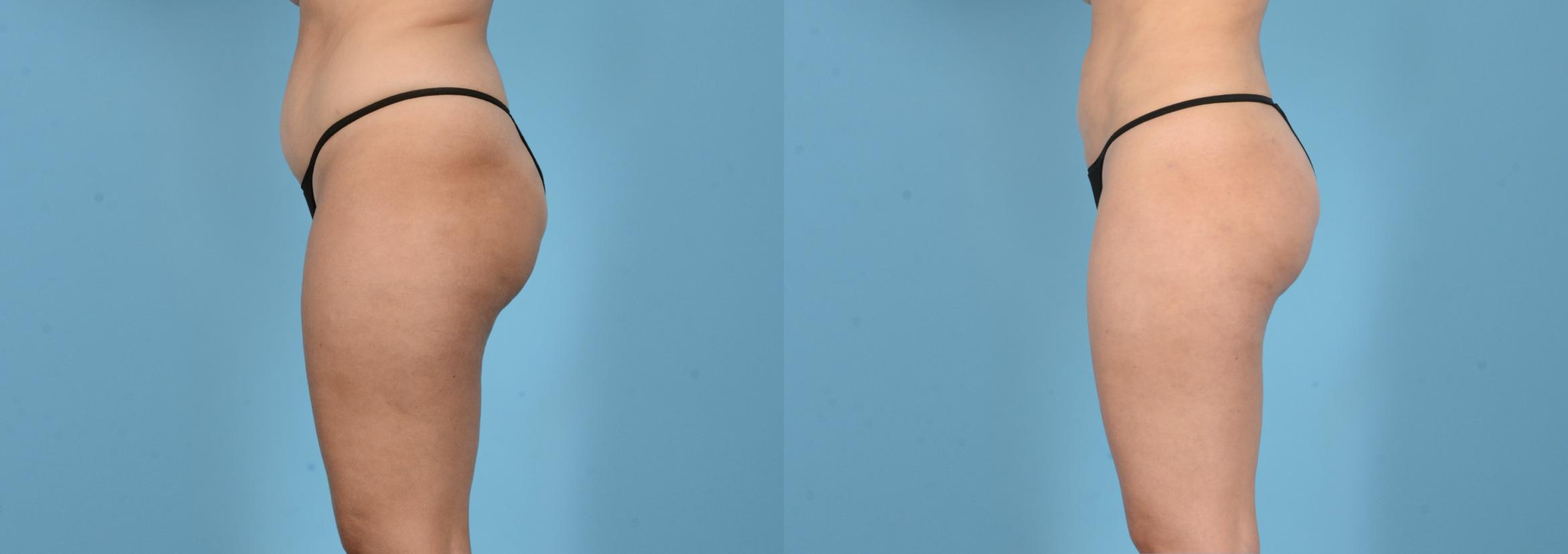 Before & After Liposuction Case 18162 Left Side View in Houston, TX