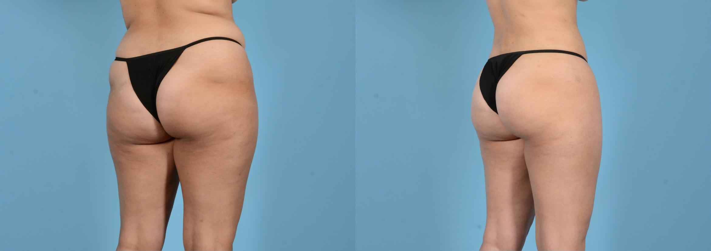 Before & After Liposuction Case 18162 Right Oblique (Back) View in Houston, TX