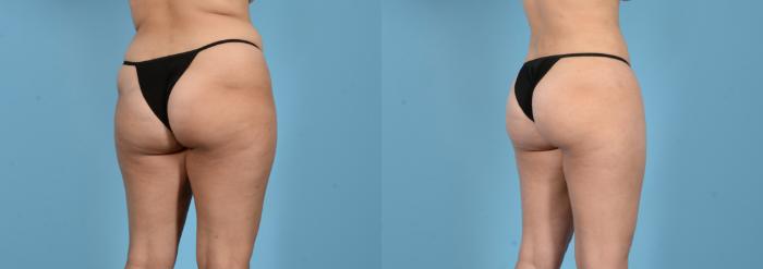 Before & After Liposuction Case 18162 Right Oblique (Back) View in Houston, TX