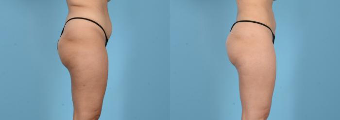 Before & After Liposuction Case 18162 Right Side View in Houston, TX