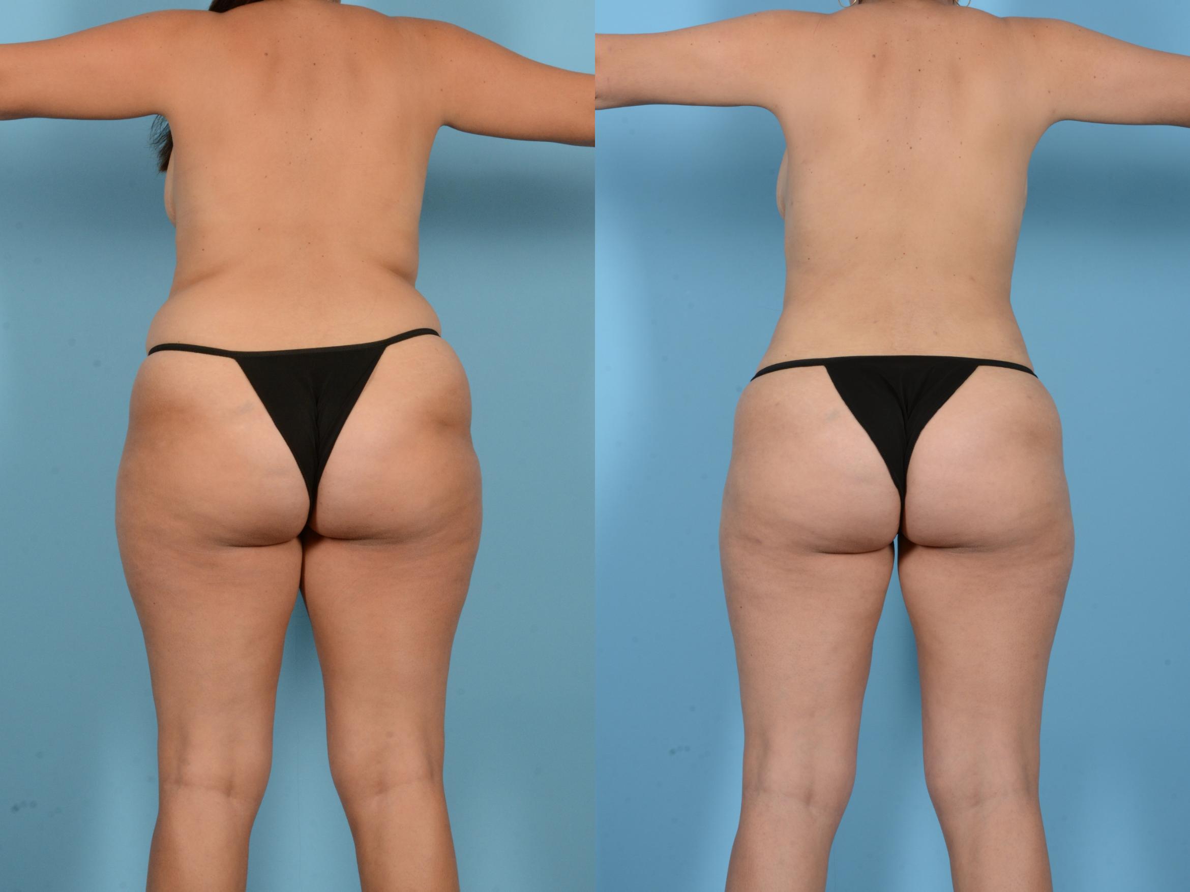 Before & After Liposuction Case 18163 Back View in Houston, TX