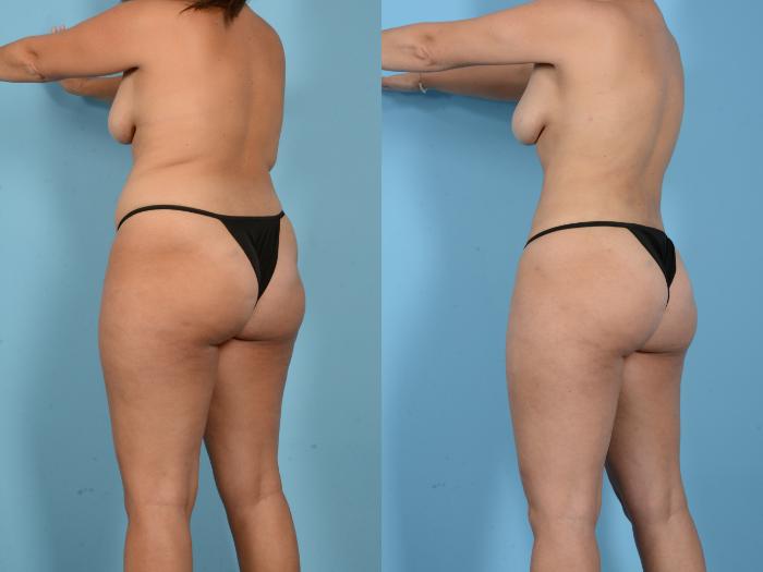 Before & After Liposuction Case 18163 Left Oblique (Back) View in Houston, TX