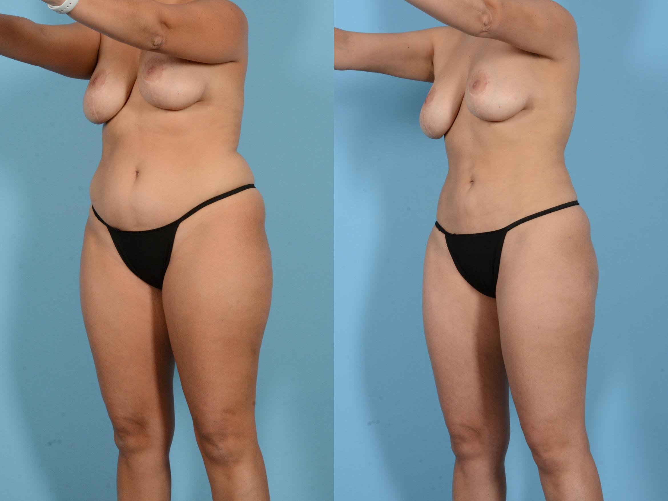 Before & After Liposuction Case 18163 Left Oblique (Front) View in Houston, TX