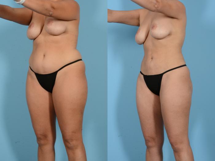 Before & After Liposuction Case 18163 Left Oblique (Front) View in Houston, TX