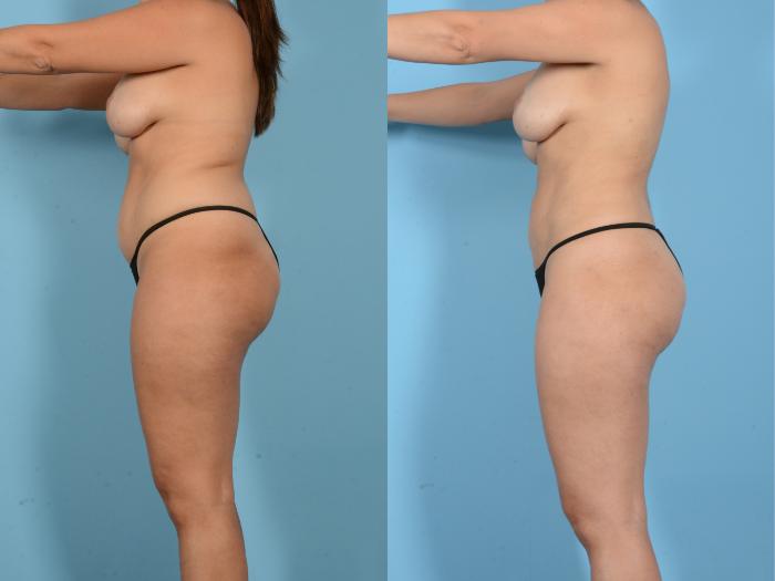 Before & After Liposuction Case 18163 Left Side View in Houston, TX
