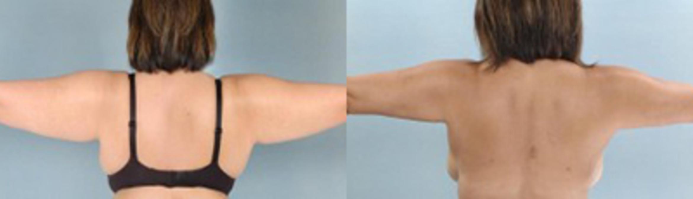 Before & After Liposuction Case 2766 View 1 View in Houston, TX